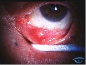 oftalmologia_infeccion_bacteriana