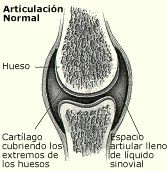 Artrosis de cadera fisiopatologia