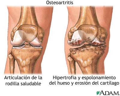 osteoartritis2