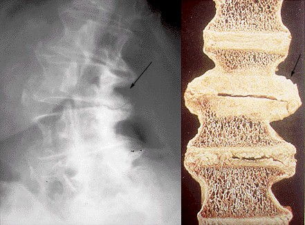osteoartritis_columna osteoartritis_columna