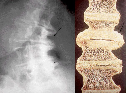 osteoartritis_columna