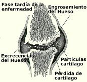 osteoartritis_fase_tardia osteoartritis_fase_tardia