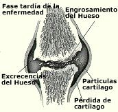 osteoartritis_fase_tardia