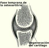osteoartritis_fase_temprana osteoartritis_fase_temprana