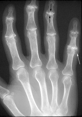 osteoartritis_rx osteoartritis_rx