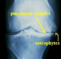 osteoartritis_rx3 osteoartritis_rx3
