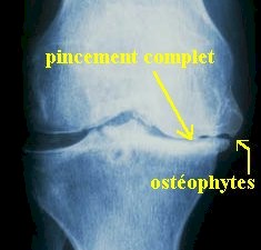 osteoartritis_rx3