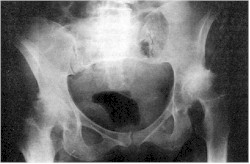osteoartritis_rx5 osteoartritis_rx5