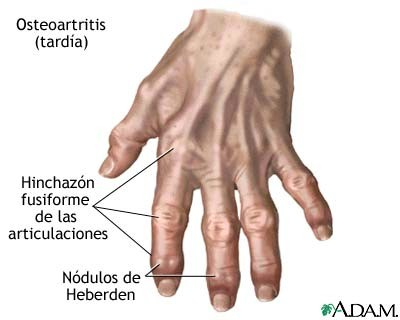 osteoartritis_tardia