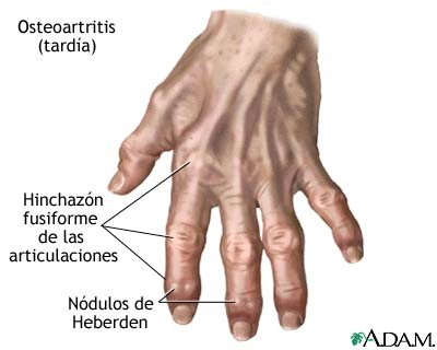 osteoartritis_tardia osteoartritis_tardia