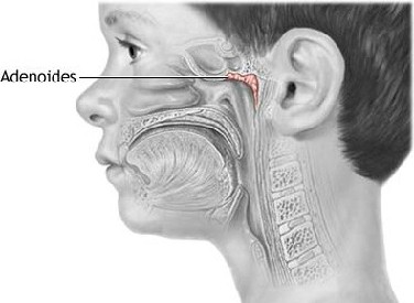 otitis_Hipertrofia_adenoidea