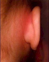 otitis_Mastoiditis