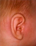 otitis_drenaje otitis_drenaje