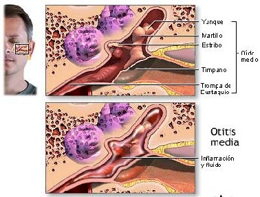 otitis_media otitis_media