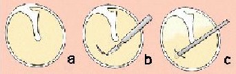 otitis_miringotomia otitis_miringotomia