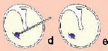 otitis_miringotomia2 otitis_miringotomia2