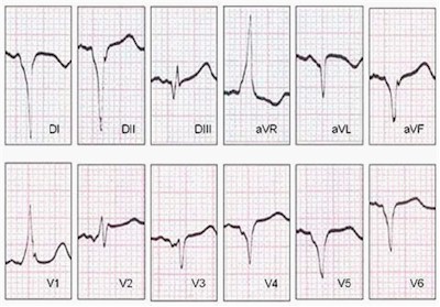 palpitaciones_taquicardias_Wolf_Parkinson_White palpitaciones_taquicardias_Wolf_Parkinson_White