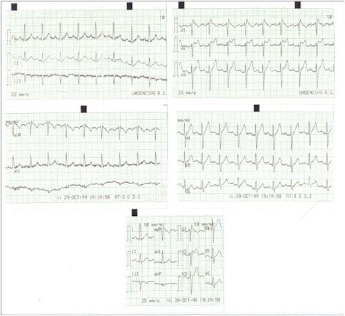 palpitaciones_taquicardias_brugada palpitaciones_taquicardias_brugada