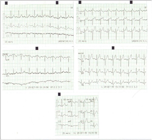 palpitaciones_taquicardias_brugada