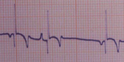 palpitaciones_taquicardias_extrasistole_ventricular