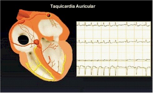 palpitaciones_taquicardias_taquicardia_auricular