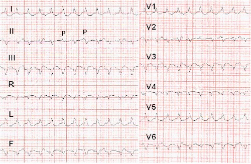 palpitaciones_taquicardias_taquicardia_ventricular palpitaciones_taquicardias_taquicardia_ventricular