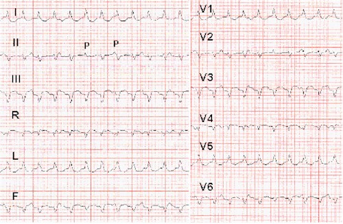 palpitaciones_taquicardias_taquicardia_ventricular