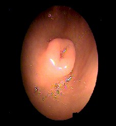 pancreas_heterotopico2 pancreas_heterotopico2