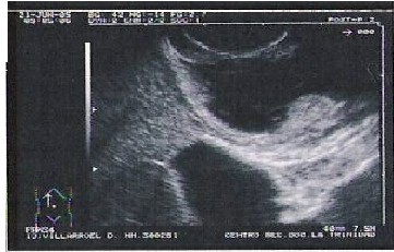 pancreas_heterotopico3 pancreas_heterotopico3
