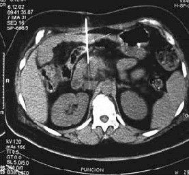 TAC_tumor_pancreas TAC_tumor_pancreas