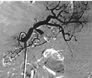 pseudoaneurisma_angiografia pseudoaneurisma_angiografia