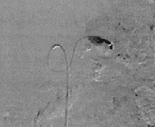 pseudoaneurisma_angiografia2 pseudoaneurisma_angiografia2