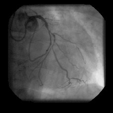 revascularizacion_miocardica_coronariografia1