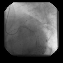 revascularizacion_miocardica_coronariografia2