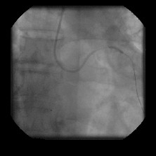 revascularizacion_miocardica_coronariografia3