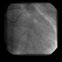 revascularizacion_miocardica_coronariografia4
