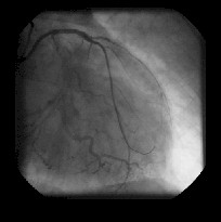 revascularizacion_miocardica_coronariografia5