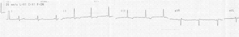 sindrome_breijo sindrome_breijo