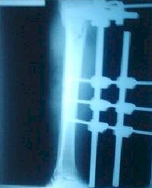 sindrome_compartimental_agudo4