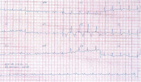 sindrome_coronario_agudo_ecg sindrome_coronario_agudo_ecg