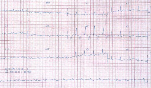 sindrome_coronario_agudo_ecg