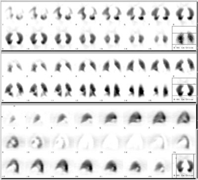 sindrome_coronario_agudo_spect sindrome_coronario_agudo_spect