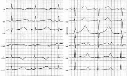 sindrome_qt_electrocardiograma