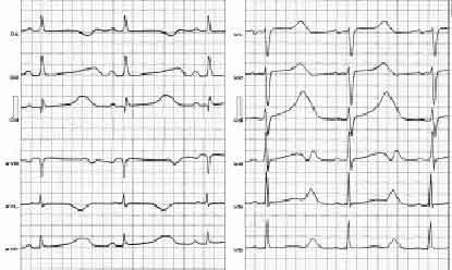 sindrome_qt_electrocardiograma