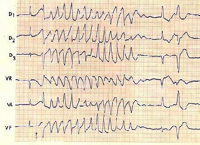 sindrome_qt_electrocardiograma2