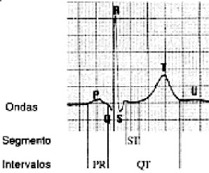 sindrome_qtlargo