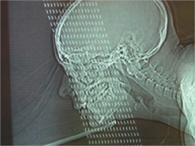 tabique_nasal_RX tabique_nasal_RX