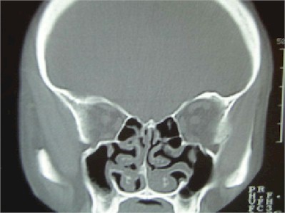 tabique_nasal_TAC tabique_nasal_TAC