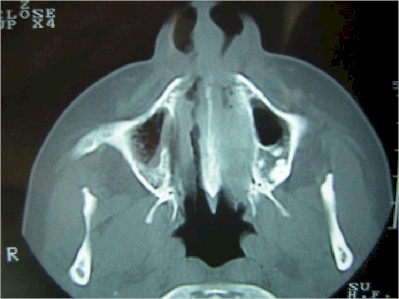 tabique_nasal_TAC2 tabique_nasal_TAC2