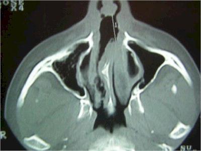 tabique_nasal_TAC3 tabique_nasal_TAC3